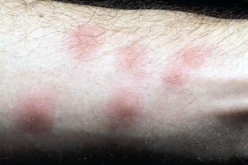 Forearm covered with red welts from bed bug bites, which appear very similar to mosquito bites.