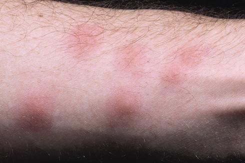 Bed bug bites cause swellings that become red and irritated when scratched.