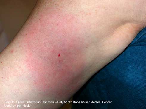 Early localized Lyme disease as evidenced by an erythema migrans rash on forearm two weeks after removal of a tick. The central red spot is where the tick attached.