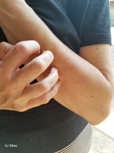 Person scratching from an itching sensation.