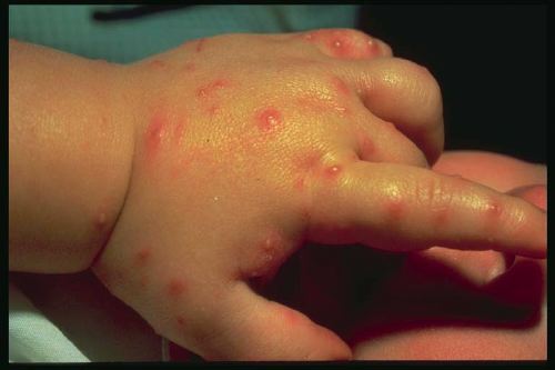 Red welts produced by the stings of red imported fire ant.