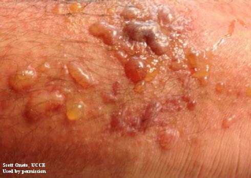 Blisters of contact dermatitis caused by poison oak exposure.